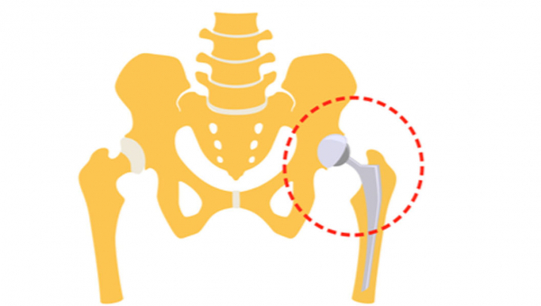حقائق عن عملية تبديل الورك في الهند