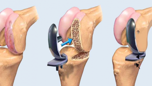 عملية تبديل الركبة في الهند