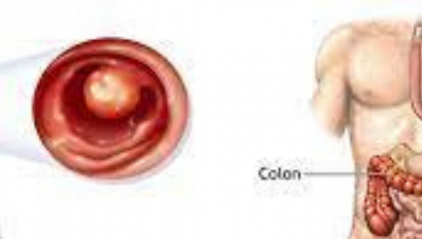 علاج سرطان القولون في الهند