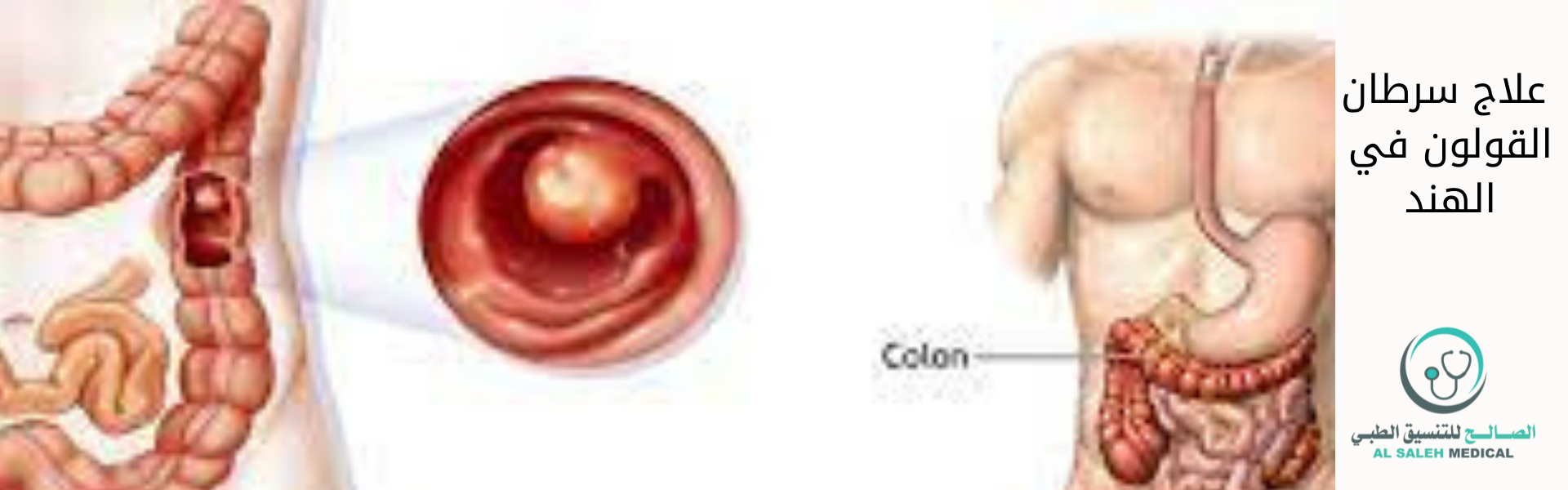 علاج سرطان القولون في الهند| أفضل الاطباء والمتستشفيات